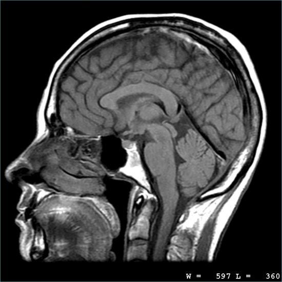 Chụp cộng hưởng từ (MRI)
