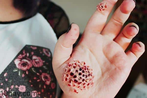 Bệnh nhiễm trùng giòi maggot